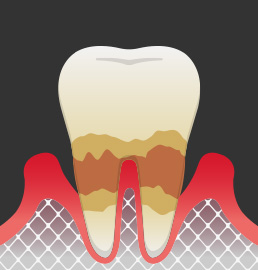 치주질환 진행단계